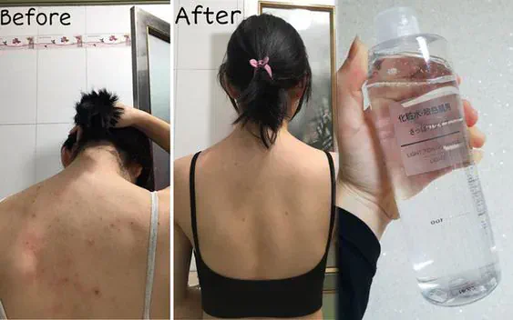 Trị mụn lưng hiệu quả