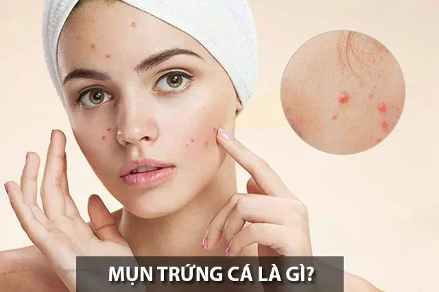 Trị mụn trứng cá