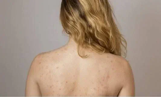 Spa trị mụn lưng uy tín tại Hà Nội: Liệu trình - Bảng Giá
