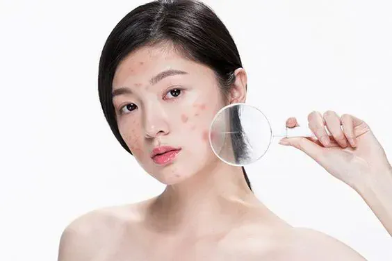 Trị mụn trứng cá tại nhà